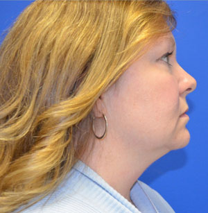Facelift Before Photo