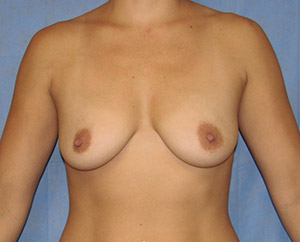 Breast Lift (Mastopexy) Before Photo