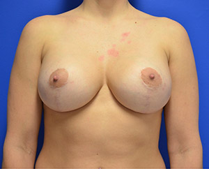 Breast Lift (Mastopexy) After Photo