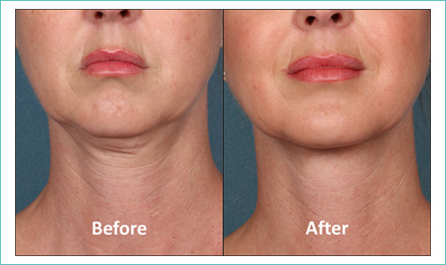 Kybella Before and After Photos