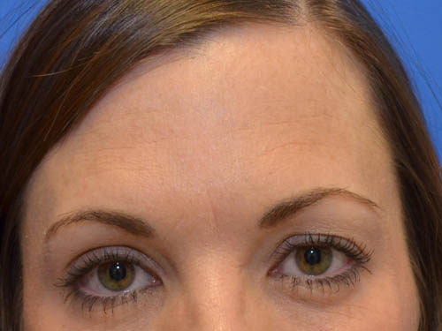 Injectable Fillers/Botox Before Photo