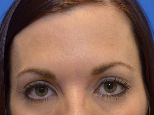 Injectable Fillers/Botox After Photo