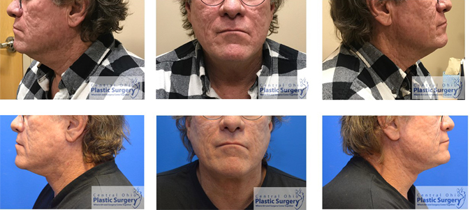 Necklift Before & After Photos