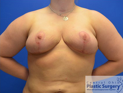 Breast Reduction After Photo