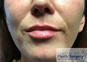 Lip Enhancement After Photo