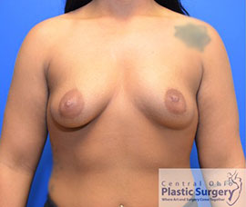 Breast Augmentation Before Photo