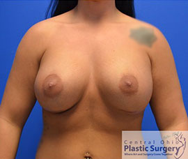 Breast Augmentation After Photo
