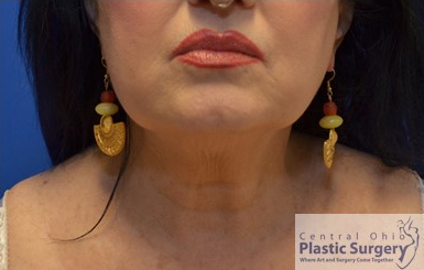 CoolSculpting Columbus, Ohio