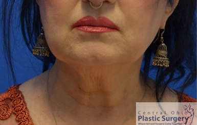 CoolSculpting Results Columbus, Ohio