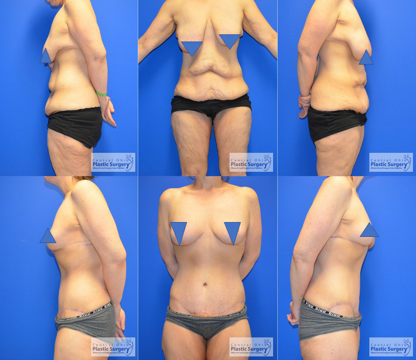 Breast Lift and Abdominoplasty Before & After Photos