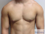 Male Breast Reduction Columbus