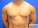 Male Breast Reduction Results Columbus