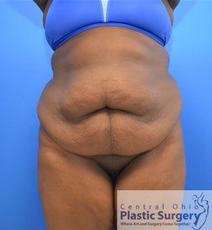 Tummy Tuck Before Photo