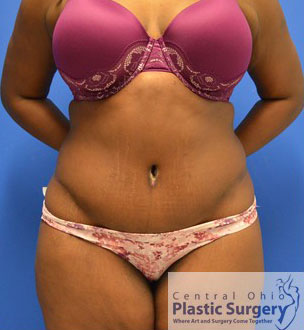 Tummy Tuck After Photo