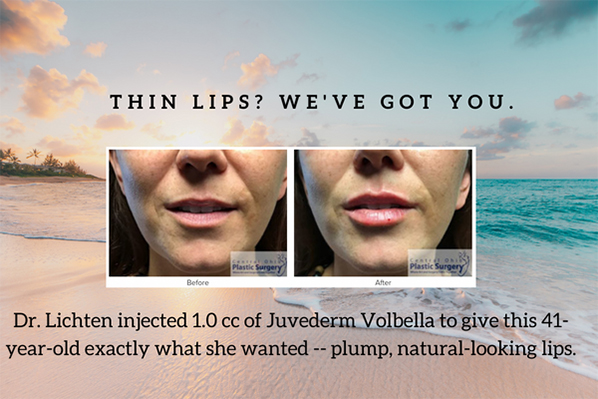 Juvederm Volbella