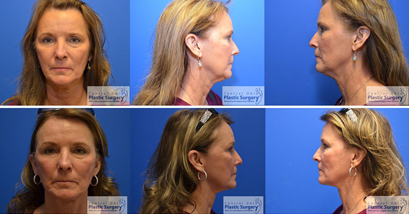 Necklift Before & After Photos